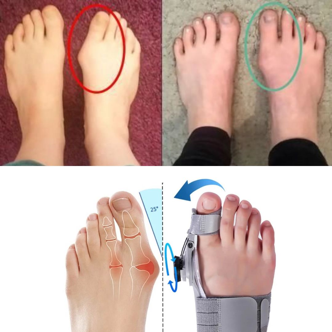Correcteur hallux valgus — progression visible