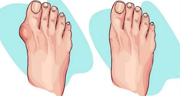 Correcteur Hallux Valgus Ajustable